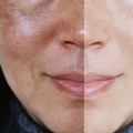 How to Achieve Improved Skin Texture at a Medical Spa