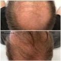 Understanding PRP Hair Restoration