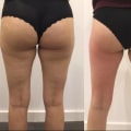 Exploring Cellulite Reduction at Medical Spas