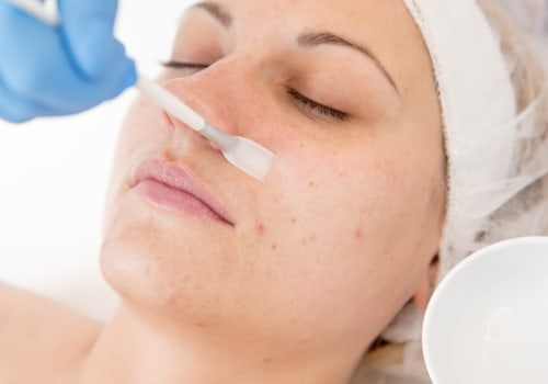 Everything You Need to Know About Chemical Peels