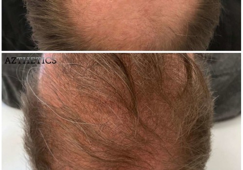 Understanding PRP Hair Restoration