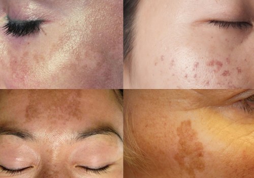 Hyperpigmentation: Understanding and Treating Skin Discoloration