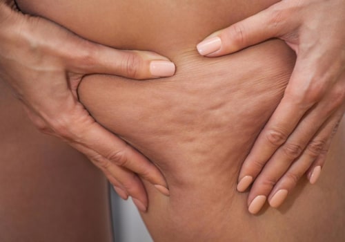 Everything You Need to Know About Cellulite Treatment at Medical Spas