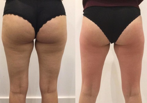 Exploring Cellulite Reduction at Medical Spas