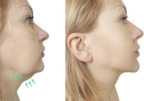 All You Need to Know About Kybella